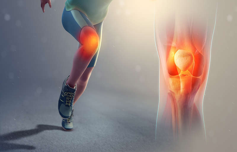 Patellofemoral Syndrome